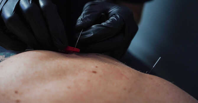 DRY NEEDLING