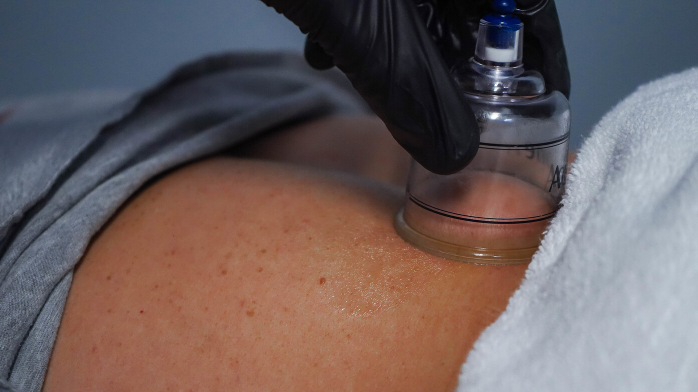Cupping, Columbus, Ohio, Upper Arlington, Worthington, Grandview, Performance Physical Therapy