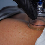 Cupping, Columbus, Ohio, Upper Arlington, Worthington, Grandview, Performance Physical Therapy