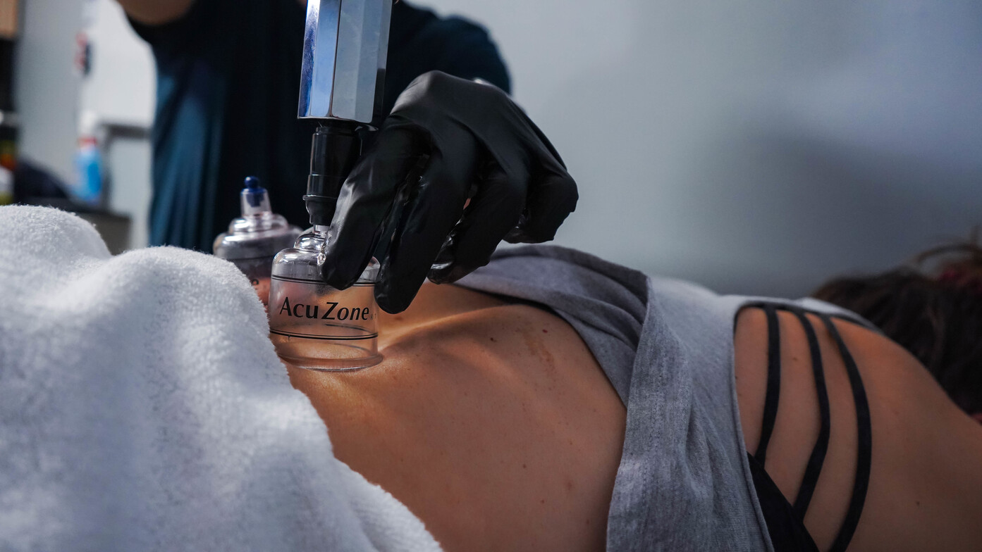 Cupping, Columbus, Ohio, Upper Arlington, Worthington, Grandview, Performance Physical Therapy